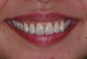 What are some good message boards about Invisalign?